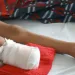 En Colombia más de 1.200 niños han sido afectados desde el año 2.000 por minas antipersona