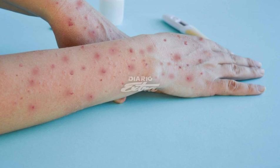 Colombia Refuerza Vigilancia ante declaratoria de Emergencia Internacional de la nueva variante del Mpox