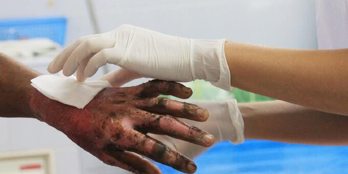 Dos personas resultaron quemadas con pólvora en Floridablanca