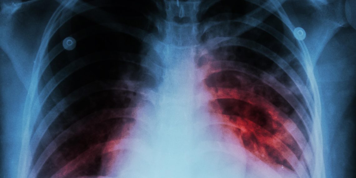 Santander el quinto departamento más afectado con 1.391 casos de tuberculosis en 2024