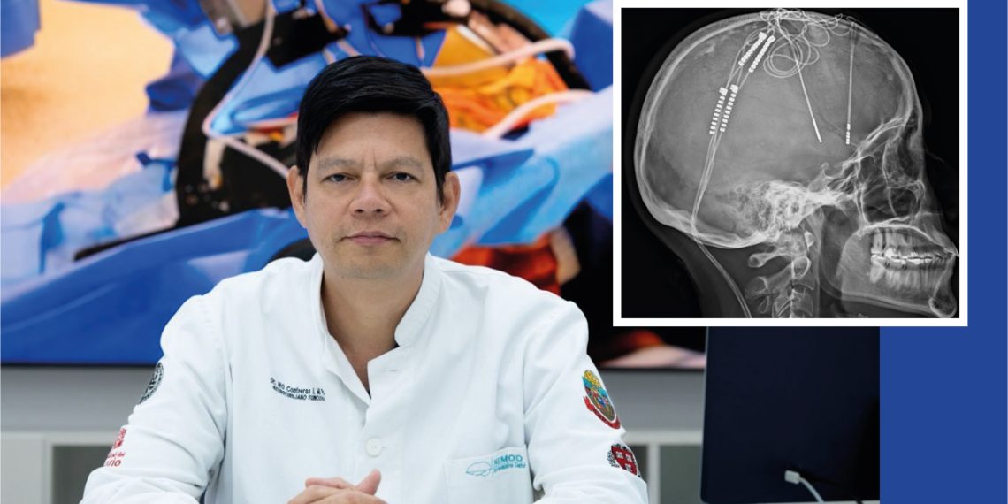 Innovación médica con rostro humano: DBS en Colombia
