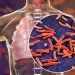 Tuberculosis en cifras: llamado urgente a la detección temprana