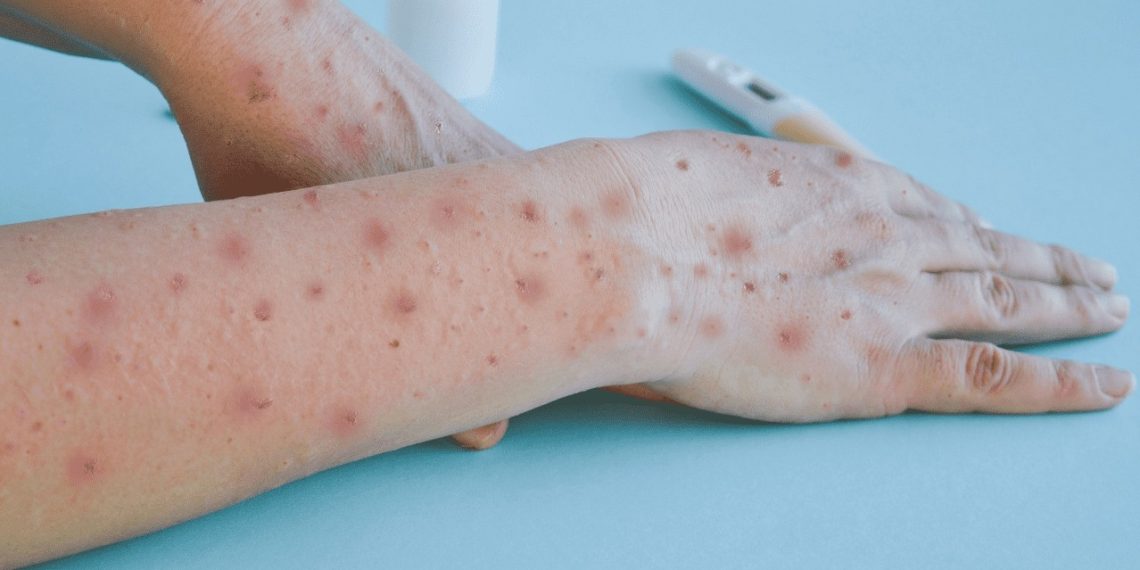 “No hay viruela símica en Barrancabermeja: Secretaría de Salud desmiente rumores”