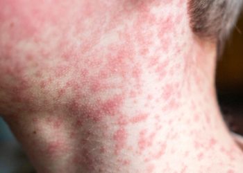 Alerta en Bucaramanga: Secretaría de Salud activa protocolos contra sarampión