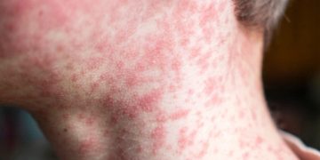 Alerta en Bucaramanga: Secretaría de Salud activa protocolos contra sarampión
