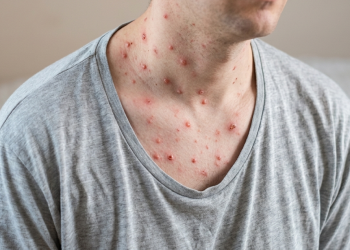 Santander enfrenta alerta sanitaria por aumento del 78% en casos de varicela en 2026